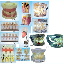 Oral Science Education Equipment Root Canal Filling Model Dental Teeth Model